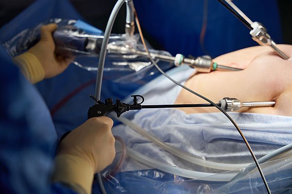 Laparoscopic Surgeries Laparoscopic Surgeries